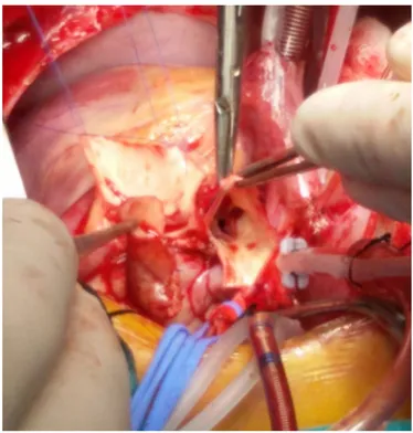Figure 3. Takeuchi procedure, the pericardial tunnel prepared for the  left coronary artery