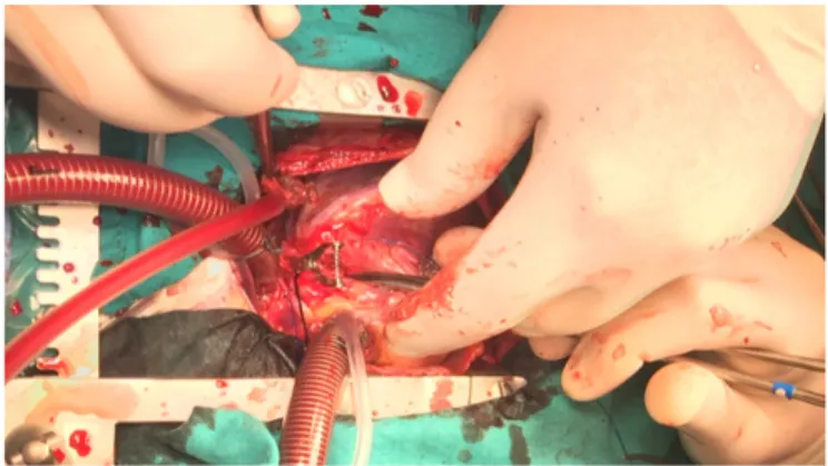 Figure 5. Bypass with the left internal thoracic artery.