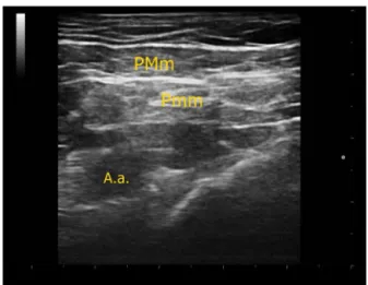 Figure 1 Sonographic anatomy of PECS type-1 block. A.a.