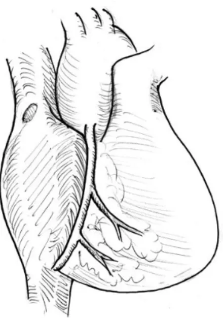Şekil  9:  Venöz  kanulasyon  sırasında  dikkat  edilmesi  gereken  sinüs  nod  ve  sağ  koroner  arterin sağ atrium ile ilişkisi görülmektedir.(13) 