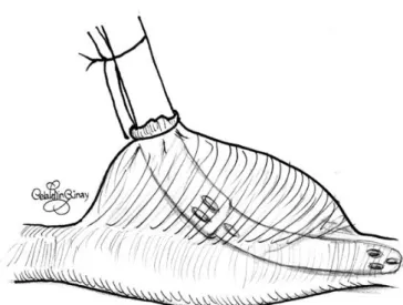 Şekil 11: Side klemple sinus nod hasarı (37) 