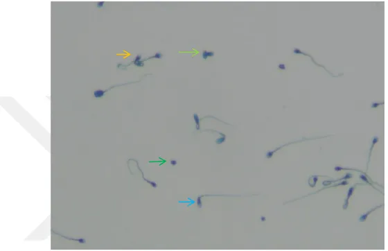 ġekil 6.2.3: Dondurma iĢlemi sonrası normozoospermik hastaların az sayıda normal  morfolojili  olan  spermleri  bulunmaktadır