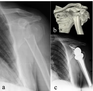 Fig. 1. Pre-operative anterior posterior shoulder radiography (a) three- three-dimensional reconstruction computerized tomography image (b) and  postoperative 4 th  month control anterior posterior radiography (c) with  the diagnosis of multi-fragmentary p