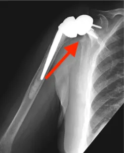 Fig. 3. 25-month control anteroposterior radiograph of a 78-year-old  patient with an RSA for rotator cuff arthropathy