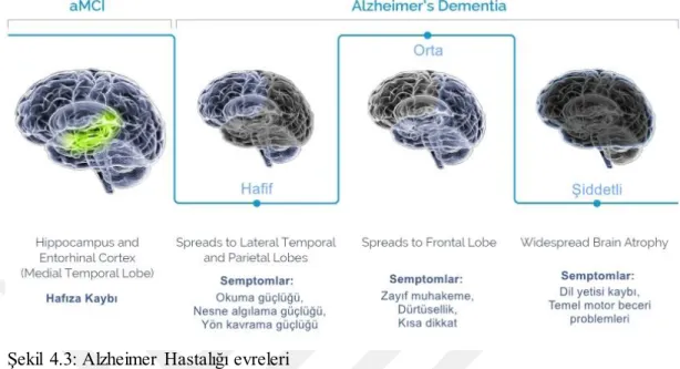 Şekil  4.3: Alzheimer  Hastalığı evreleri 