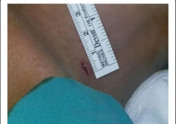 Fig. 1 Primary Incision