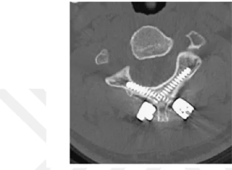 Figure 3.4: Axial CT Scan of Wrights bi-lateral crossing screw fixation [36]