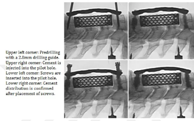 Figure 3.7: Bi-level corpectomy with cement augment screw-plate system [42]