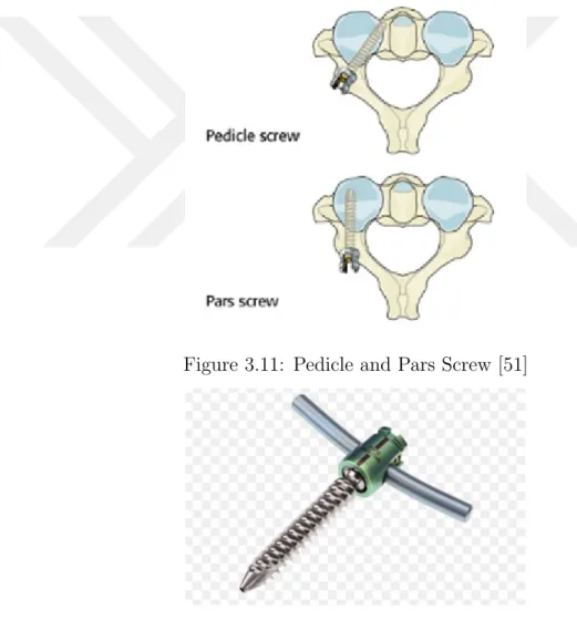 Figure 3.11: Pedicle and Pars Screw [51]