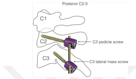 Figure 3.13: Lateral view of C2 pedicle and C3 lateral mass screw fixation [53]