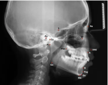 Fig.  1.  Examples  for  cephalometric  hard  tissue  landmarks.  A:  The  deepest point of concavity on the maxilla between ANS and prosthion