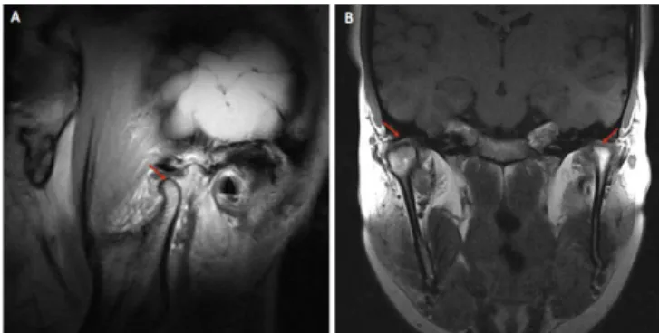 Fig. 4. Imaging of the TMJ region and mandibular condyle in sagittal  (A) and coronal (B) sections on MR images 