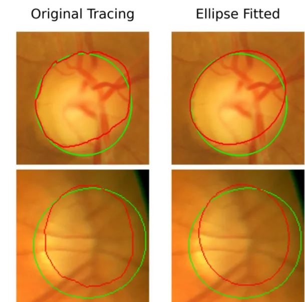 Fig 5. Images obtained from the Drishti and ARIA datasets showing ellipse fitting lead to lower precision in the traced disc region
