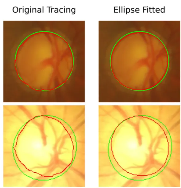Fig 4. Images obtained from the Drishti and ARIA datasets showing improved disc tracing when ellipse fitting is applied