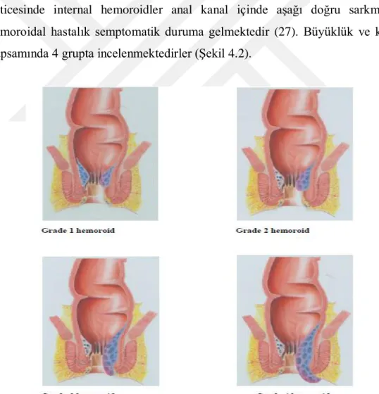 Şekil 4. 1. 5. 1. 1.  Hemoroid Dereceleri 