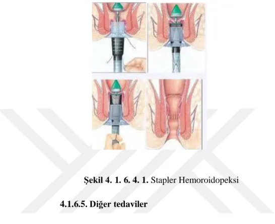 Şekil 4. 1. 6. 4. 1. Stapler Hemoroidopeksi  4.1.6.5. Diğer tedaviler 