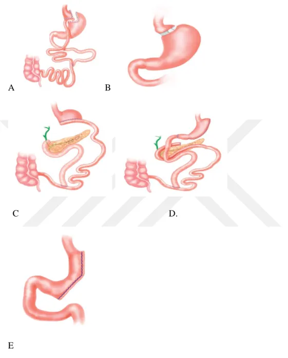 Şekil  4.2.1.  Geleneksel  cerrahi  işlemler.  (A)  Roux-en-Y  gastrik  bypass.  (B)  Laparoskopik  ayarlanabilir mide bandı