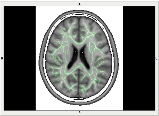 Fig. 4 Mean skeleton image deduced from 30 subjects ’ data is overlaid on a multislice axial structural image