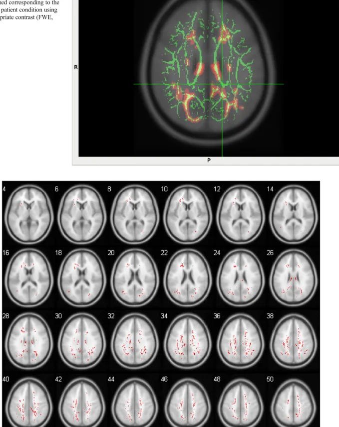 Fig. 6 Voxelwise statistics for two-group comparison are performed using GLM on aligned FA images, and the statistical maps are obtained corresponding to the control > patient condition using the appropriate