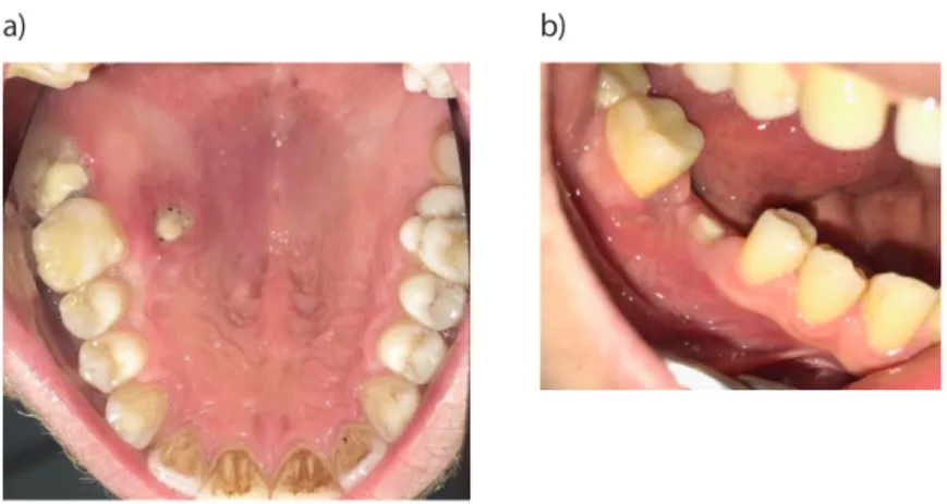 Figure 1. a-b. The necrotic area extending to the bone on the right side of the hard palate (a)
