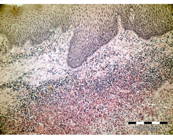 Figure 3. a-b. Langerhans cells and a large number of eosinophil polymorphs in the connective tissue (H&amp;E X200)  (a)