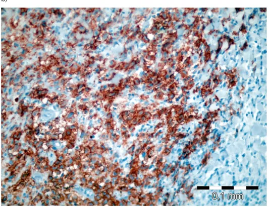 Figure 4. The increased FDG uptake at the posterior of left iliac bone
