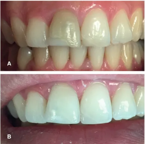 Figure 3. Inside/outside bleaching case with 10% carbamide peroxide (A) Initial photography of the patient with a  trauma induced discoloration (B) 7-month follow-up photography of the case