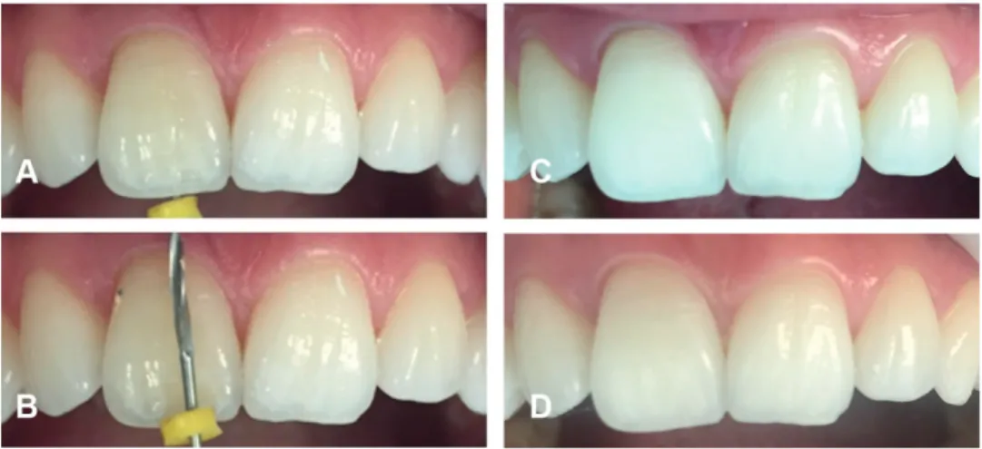 Figure 4. Endodontic treatment related discoloration (A) and (B) removal of endodontic material to the proximal  bone level (C) overbleached tooth (D) 11-month follow-up photography