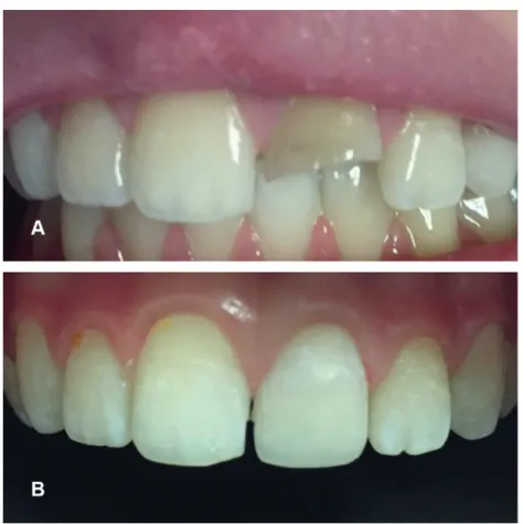 Figure 1. A case representing the walking bleach technique (A) Initial photography of trauma induced discoloration  and fracture (B) 6-month follow-up photography of the case postbleaching with 10% carbamide peroxide