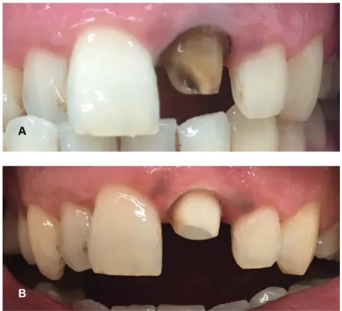 Figure 2. A preprosthetic case representing the nonvital power bleaching using 38% hydrogen peroxide with  light activation (modified nonvital power bleaching) (A) Initial photography of endodontically treated tooth (B)  Postbleaching photography after 2 w