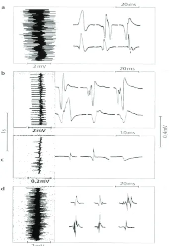 Figure 1:Normal, myopathic and neurogenic EMG signals [Mumenthaler and Mattle, (2002)].