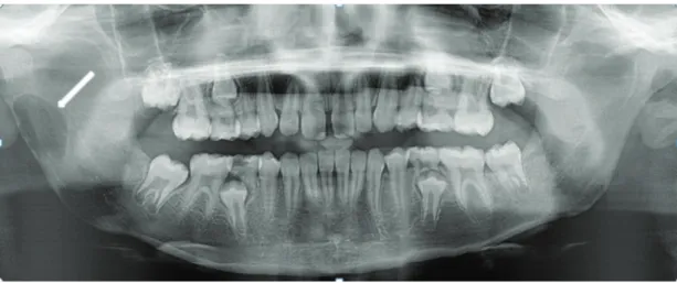 Figure 1. Preoperative panoramic radiography showing well defined radiolucent lesion of the mandibular right  ramus (arrow).