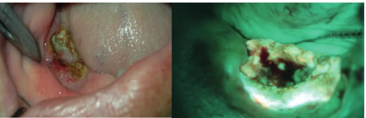 Figure 7. The oro-antral perforation on the necrotic area extending to the zygomatic crista in a patient using  zoledronic acid for breast cancer.