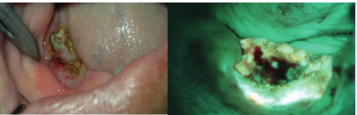 Figure 7. The oro-antral perforation on the necrotic area extending to the zygomatic crista in a patient using  zoledronic acid for breast cancer.