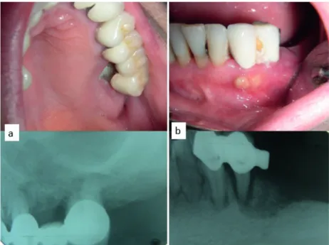 Figure 1. (a) Clinical and radiological view of bone necrosis around the teeth 27 after 10 months administration of i.v  zoledronic acid in breast cancer (b) Diffuse bone necrosis in the clinical and radiological image of the same patient  resembling perio