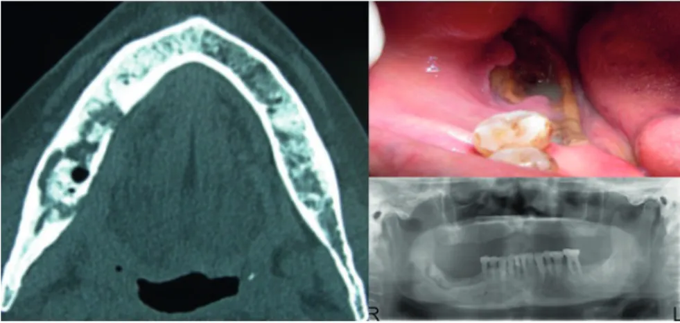 Figure 5. (a)The necrotic bone related i.v. zoledronic acid administration in patient with breast cancer