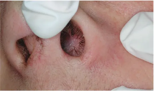 Figure 2. Appearance of the cyst from the nasal cavity.