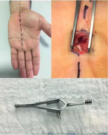 Figure 1. The incision line parallel to the medial of the ring finger, the mini-distal 1-1.5 cm skin incision and the   mini-skin retractor.