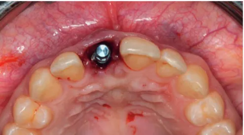 Figure 4. The placed implant immediately after extraction