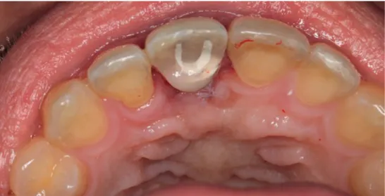 Figure 7. The screw access channel was filled with a composite resin