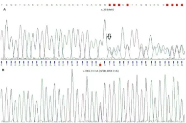 Figure 1. Electropherograms of the patient.