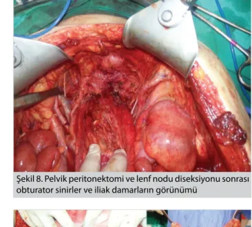 Şekil 9. Tamamlanmış sağ diyafragmatik peritonektomi,  diyafragmatik liflerin çıplak görünümü ve çıkarılan spesimen  (mavi ok sağ böbrek, siyah yıldız sağ adrenal bez)