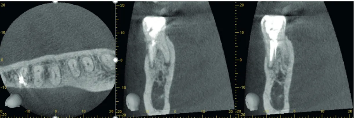 Figure 2. a) Clinical view of the tooth after access cavity b) Radiographical view of localized missing canal c)  Radiographical view of master con d) Clinical view of the tooth after filling the canal and placing flowable composite