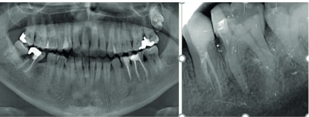 Figure 3. After 1-year follow-up radiograps