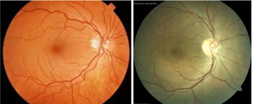 Şekil 2.3. Normal ve makular dekolmanlı göz. Solda normal makular alan [24], sağda ise SSR tanısı          almış hasta grubundan bir olgunun makular alanda oluşan seröz dekolmanı gösterilmektedir