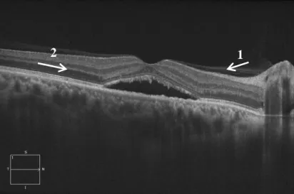 Şekil 2.4. SSR tanılı bir olguda meydana gelen subretinal sıvıda makular elevasyonunun optik            kohorens tomografi (OKT) görüntüsü