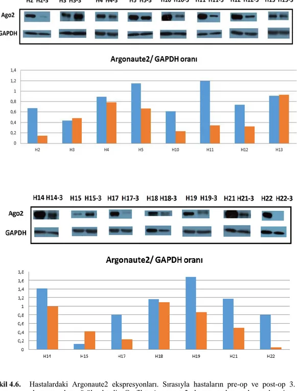ġekil 4.6.  Hastalardaki  Argonaute2  ekspresyonları.  Sırasıyla  hastaların  pre-op  ve  post-op  3