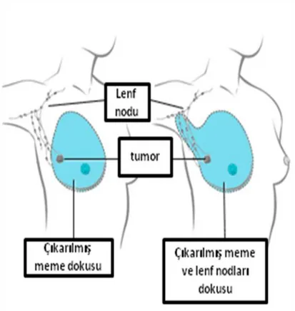 Şekil 2.5.1. Tüm (sol) ve modifiye radikal (sağ) mastektomi (Mastectomy. 2004,                    Medbroadcast, Canada, viewed 18 October 2011, 