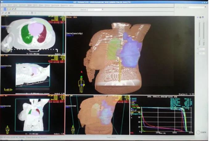 Şekil 3.5. CMS XIO Tedavi Planlama Sistemi Ekran görüntüsü. 