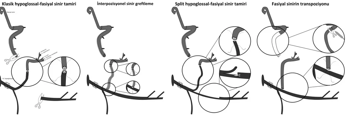Şekil 2.1.Hypoglossal-fasiyal sinir tamir metotları 